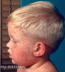 Детские инфекционные заболевания: Краснуха - MY-DOKTOR.RU