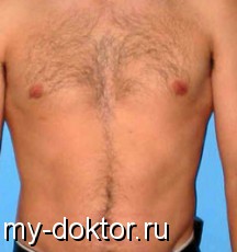 Как бороться с нежелательными волосами у мужчин. Рекомендации специалистов - MY-DOKTOR.RU
