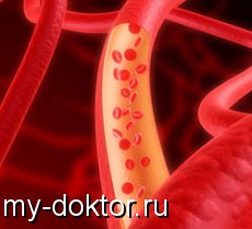 Как не стать жертвой атеросклероза? - MY-DOKTOR.RU