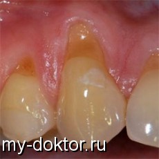 Клиновидный дефект — не кариозное поражение эмали зубов - MY-DOKTOR.RU