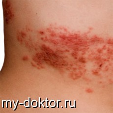   (Herpes zoster) - MY-DOKTOR.RU