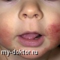 Аллергия у малыша – действуй немедленно! - MY-DOKTOR.RU