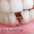 Ассортимент зубных имплантов – разбираемся в качестве и доступности - MY-DOKTOR.RU