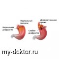 Диафрагмальная грыжа: причины, диагностика и лечение - MY-DOKTOR.RU