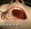 Экстренная помощь будущей маме при острой зубной боли - MY-DOKTOR.RU