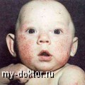 Геморрагические диатезы - MY-DOKTOR.RU