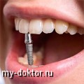 Имплантация зубов: за и против, преимущества и особенности услуги - MY-DOKTOR.RU