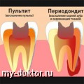 Как проходит лечение периодонтита зуба - MY-DOKTOR.RU