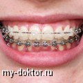 Как выравнивают зубы с помощью брекетов - MY-DOKTOR.RU