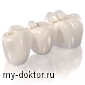 Какой зубной протез выбрать - MY-DOKTOR.RU