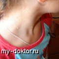 Контагиозный моллюск. Причины, симптомы и лечение - MY-DOKTOR.RU