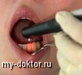 Новые возможности в стоматологии: лечение зубов лазером - MY-DOKTOR.RU