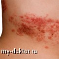   (Herpes zoster) - MY-DOKTOR.RU