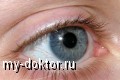 Ожоги глаз - MY-DOKTOR.RU