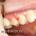 Периодонтит. Его проявления и лечение - MY-DOKTOR.RU