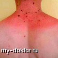 Рак кожи - MY-DOKTOR.RU