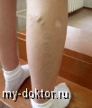 Риски развития варикозной болезни - MY-DOKTOR.RU