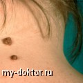 Родинка или меланома. 2 вопроса дерматологу (вопрос-ответ) - MY-DOKTOR.RU