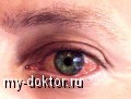 Симптом: покраснение глаз. Коньюктивит - MY-DOKTOR.RU