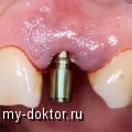 Виды зубных имплантатов - MY-DOKTOR.RU