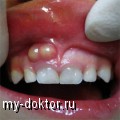 Воспалительное заболевание – зубной флюс - MY-DOKTOR.RU