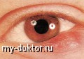 Ячмень на веке, или блефарит. Советы против недуга - MY-DOKTOR.RU